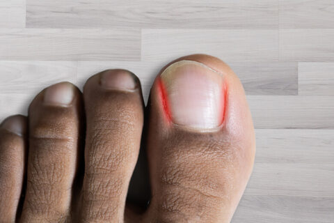 Ingrown Toenails Causes Symptoms And Treatment