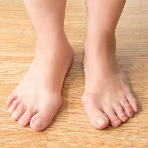 bunions treatable condition active alignment orthotics and bracing