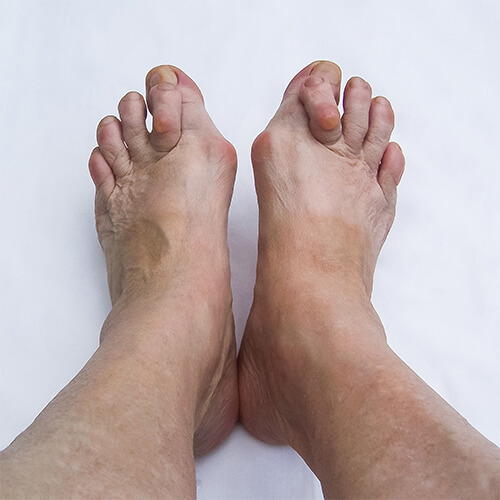 toe deformities treatable condition active alignment orthotics and bracing