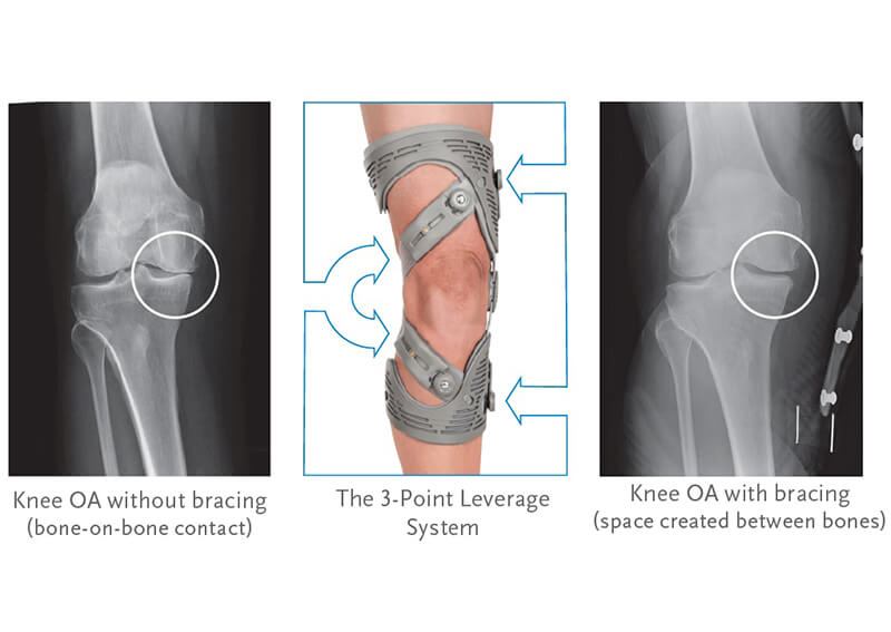 Bracing - Active Alignment Orthotics, Bracing & Foot Care