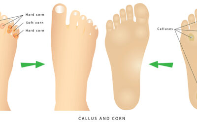 Calluses and Corns