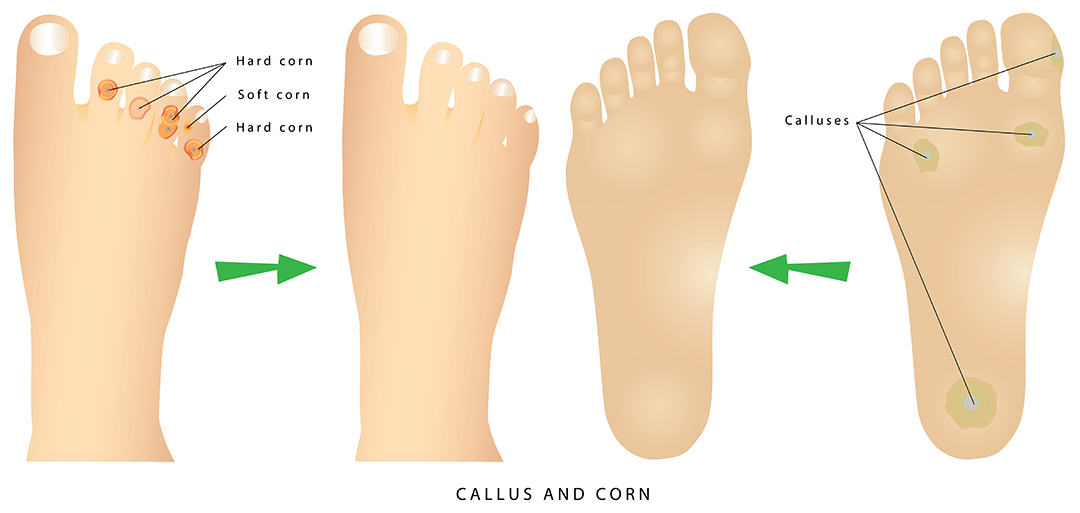 calluses and corns Definitions, Differences, and Treatment Options