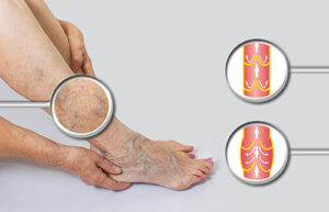 what is compression therapy varicose veins