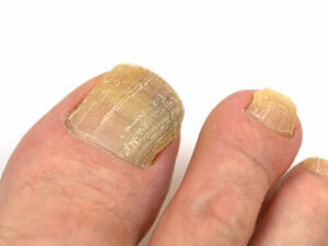 toenail fungus lose toenails yellow