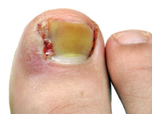ingrown toenail painful toenails 