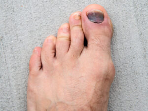 toenail trauma lose nail toe bruising pain