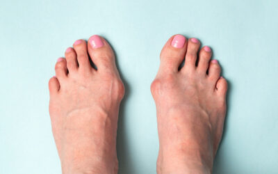 The Difference between a Bunion and Hallux Valgus