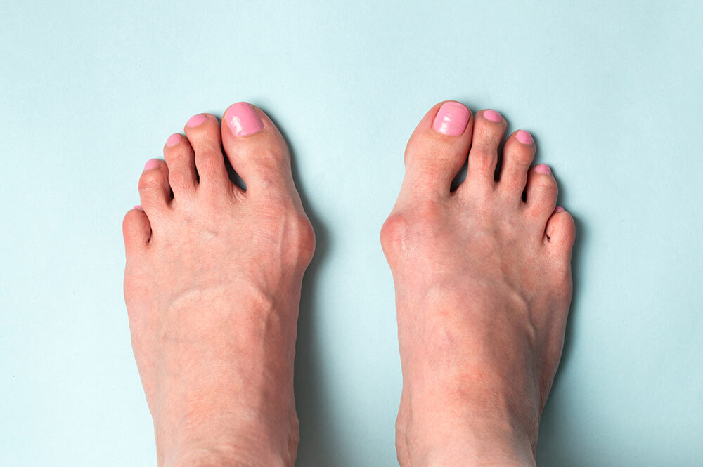The Difference between a Bunion and Hallux Valgus senior foot feet conditions symptoms treatment