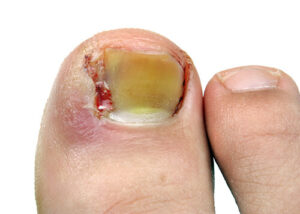 Ingrown Toenails  Advanced Foot & Orthotic Clinic