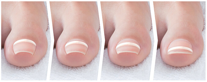 Innova Spa  Ingrown Toenail Treatments