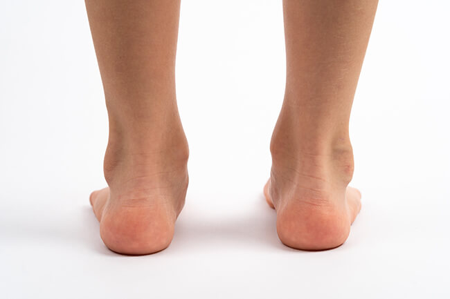 flat feet pronation overpronation foot conditions