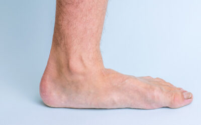 Understanding Flat Feet