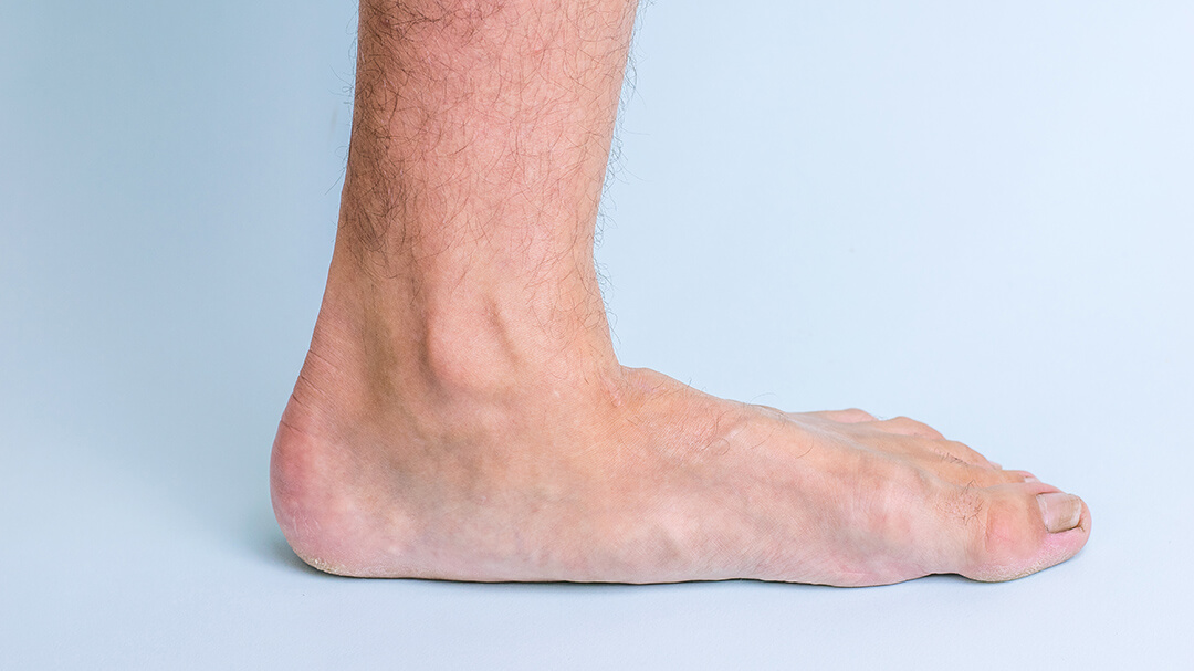 flat feet causes symptoms treatments