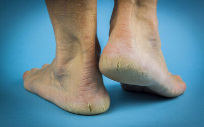 Cracked Heels – A Painful but Treatable Condition