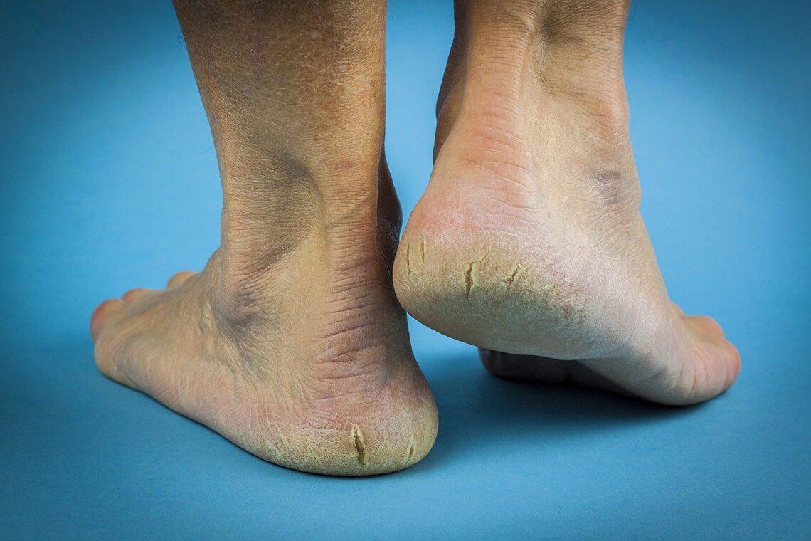 cracked heels feet skin causes symptoms appearance treatment